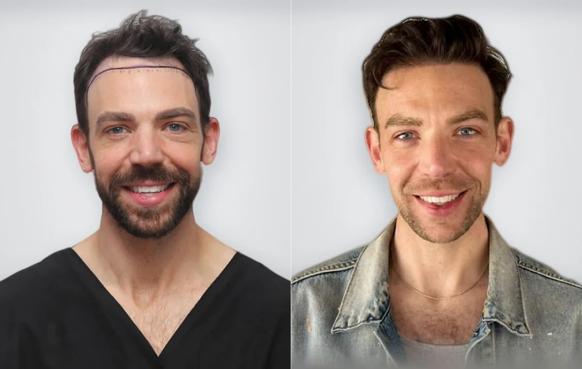 Daniel Coffman before and after hair transplant