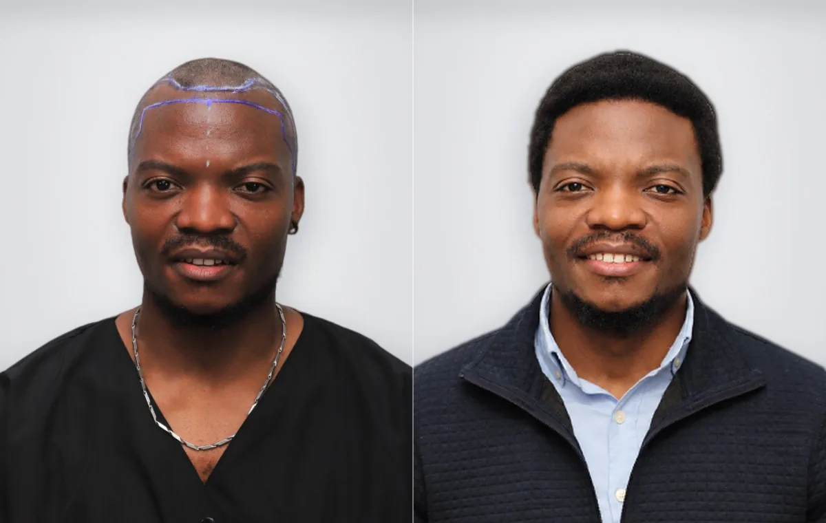 Fabuert Joseph before and after afro hair transplant