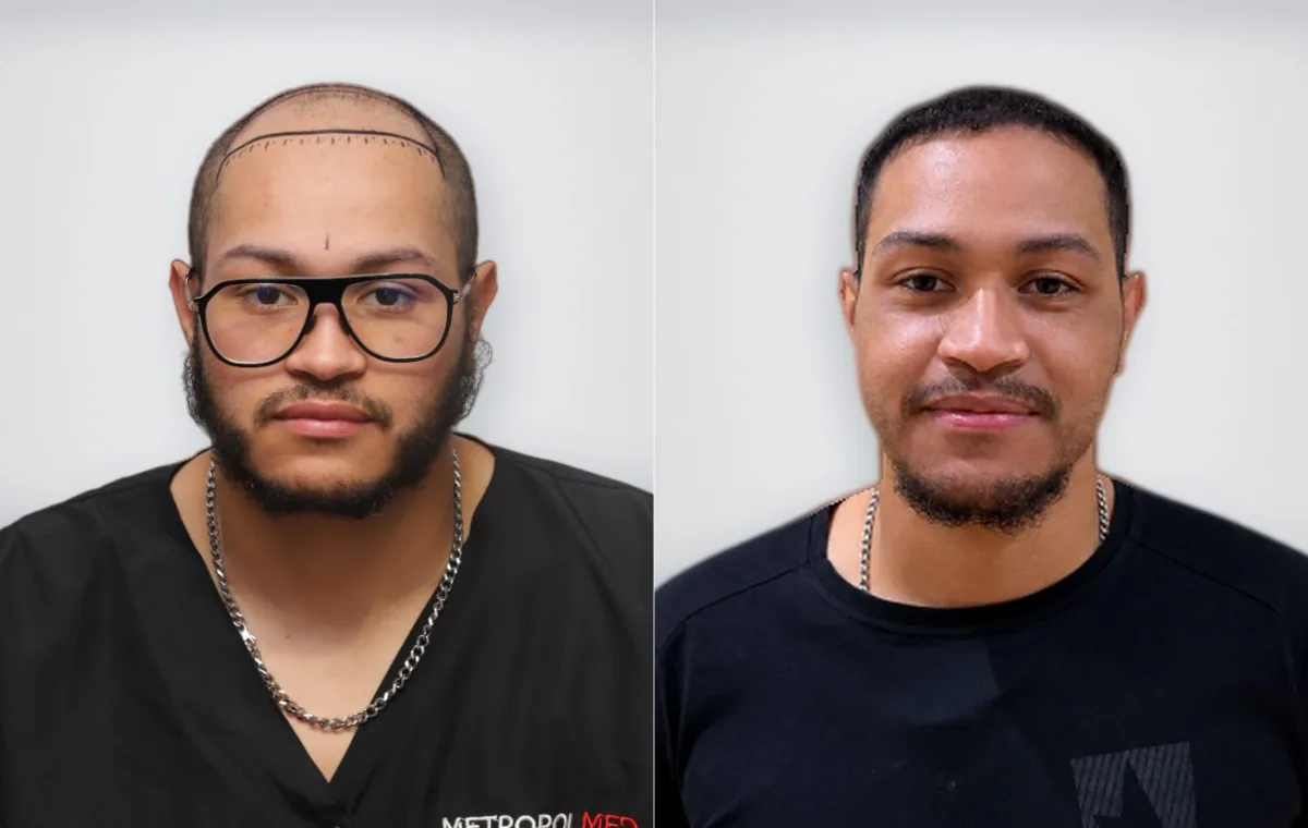 Hoyam Aity before and after hair transplant