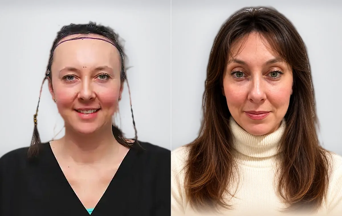 Irina Shirley before and after hair transplant