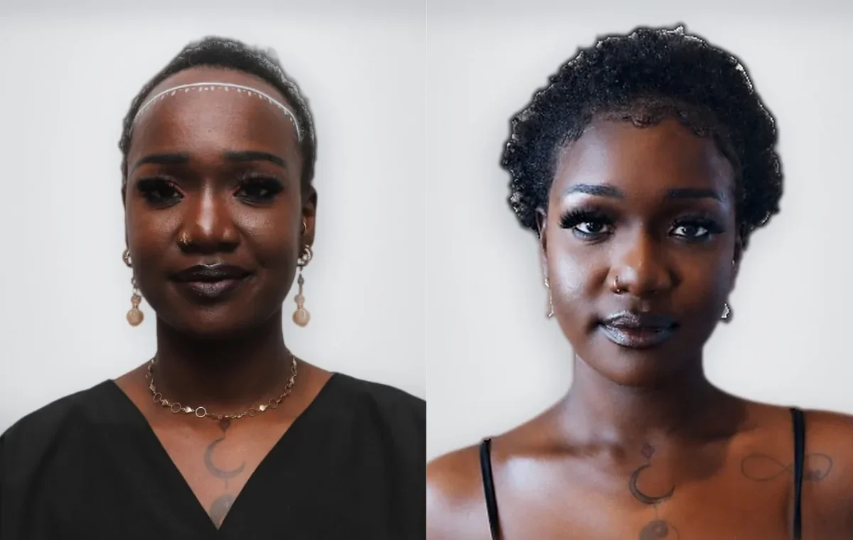 Janet Mai Sawyer before and after hair transplant