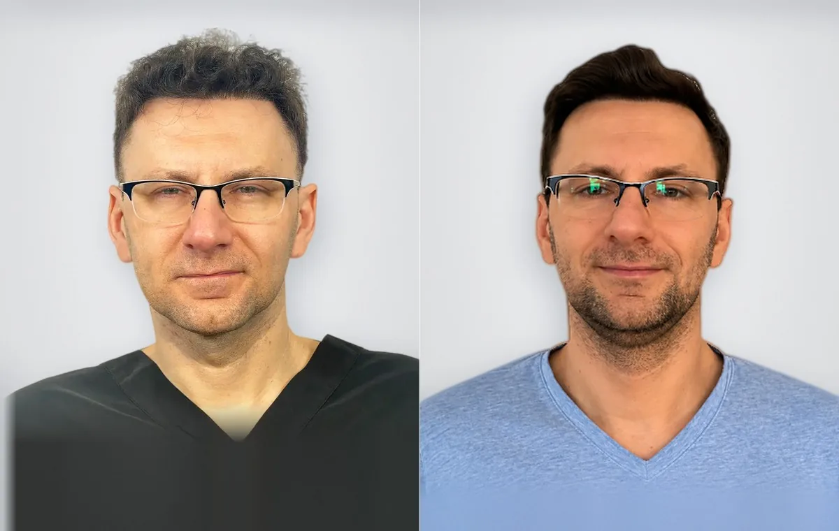 Jaroslaw Traczynska before and after hair transplant