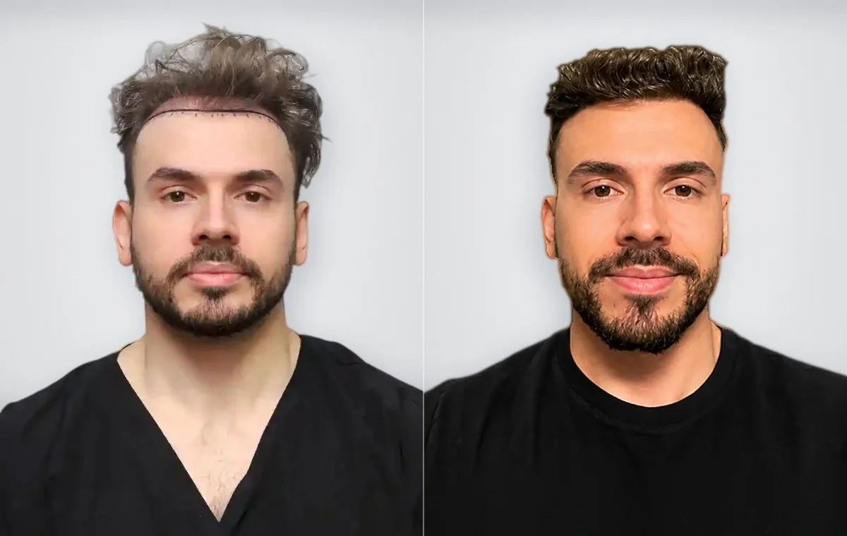 Lucas Santana Soave before and after hair transplant