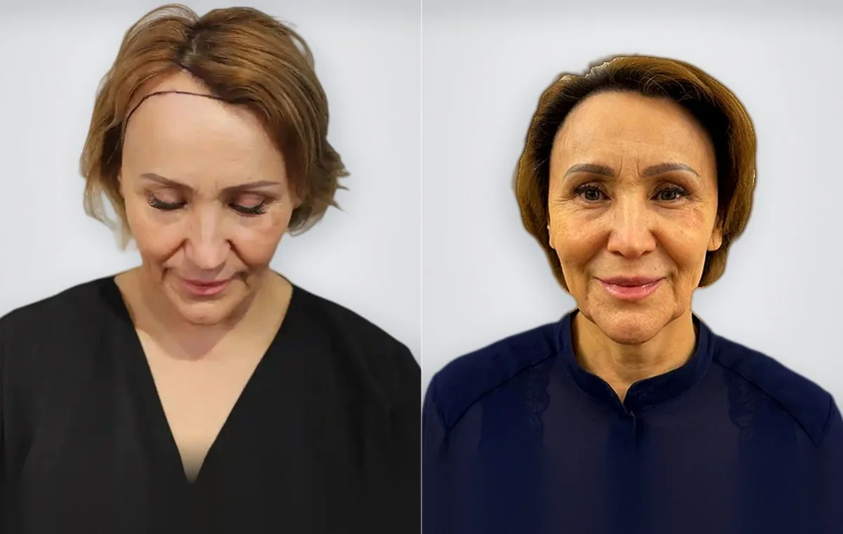 Roza Agibayeva before and after women's hair transplant