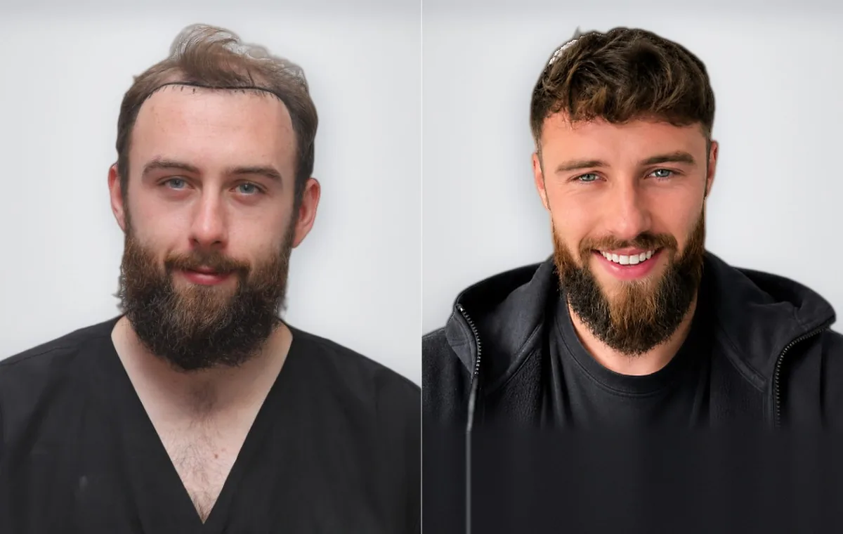 Sean Deverill before and after hair transplant