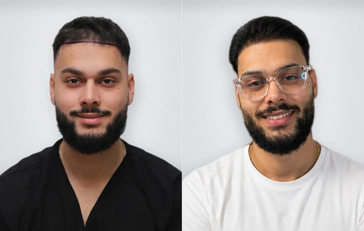 Sinan Sinay before and after hair transplant