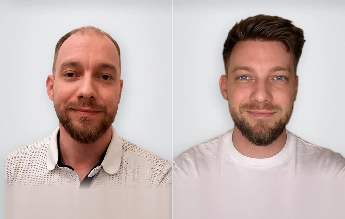 Tibor Jánoška before and after hair transplant